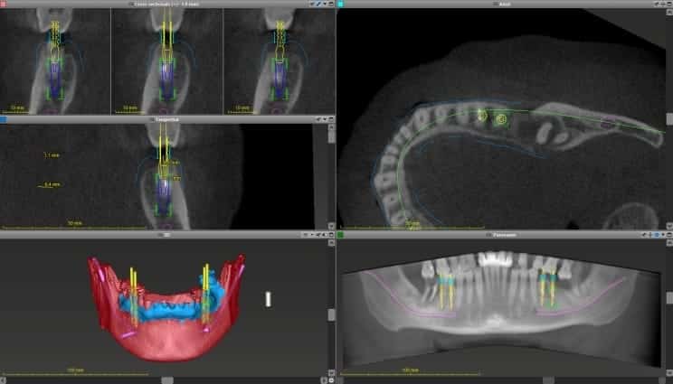 3D IMPLANT PALNNONG תכנון תלת מימדי של השתלות