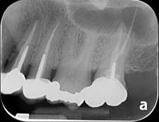 בתמונה לעיל ניתן לראות שיניים עם טיפולי שורש. בצילום הרנטגן, השן נראית עם פסים לבנים בתוכה, זוהי סתימת השורש.